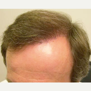 38 year old man treated with FUE Hair Transplant after 3564741