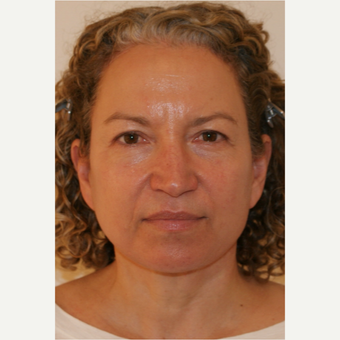 45-54 year old woman treated with Facelift after 3419925