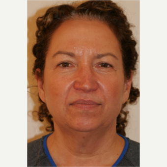 45-54 year old woman treated with Facelift before 3419925
