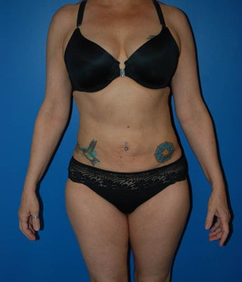 Belly Button surgery with Liposuction after 1184527