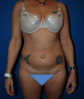 Belly Button surgery with Liposuction before 1184527
