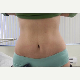 35-44 year old woman treated with Tummy Tuck after 1582985