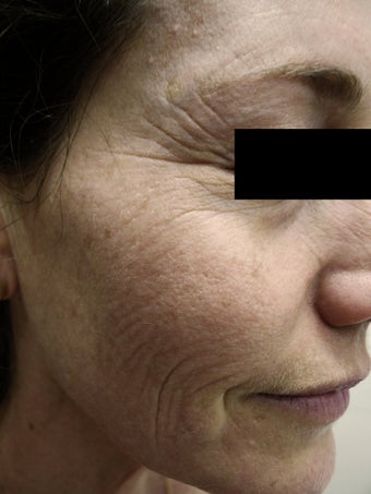 CO2 Laser to Improve Skin before 1510662