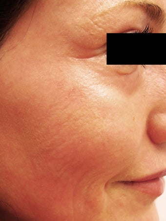 CO2 Laser to Improve Skin after 1510662