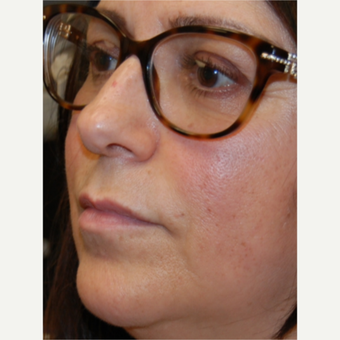 55-64 year old woman treated with Silikon 1000 for Lip Augmentation - Two treatments before 3542362