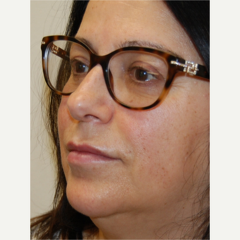 55-64 year old woman treated with Silikon 1000 for Lip Augmentation - Two treatments after 3542362