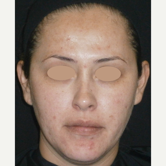 35-44 year old woman treated with Acne Treatment after 3150232