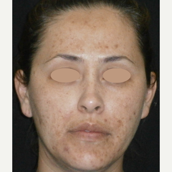 35-44 year old woman treated with Acne Treatment before 3150232