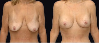 Breast lift with implants after weight loss before 1142582