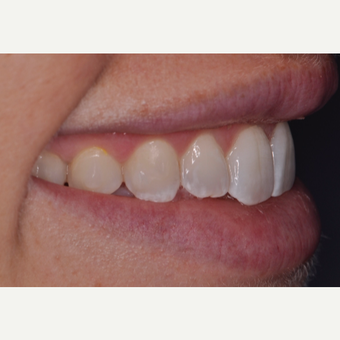 30 year old woman treated with Porcelain Veneers before 3538257