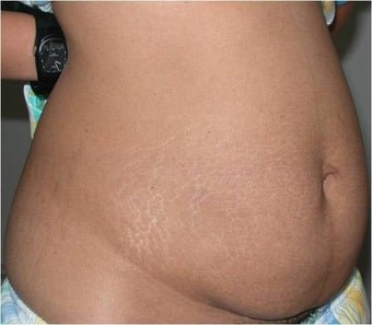Liposculpturing before 618130