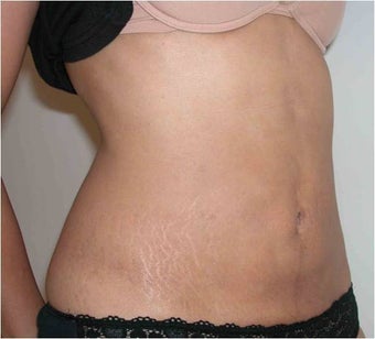 Liposculpturing after 618130
