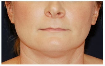 Chin Liposuction before 1340876