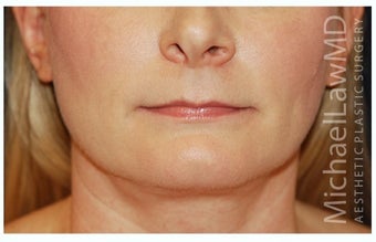 Chin Liposuction after 1340876