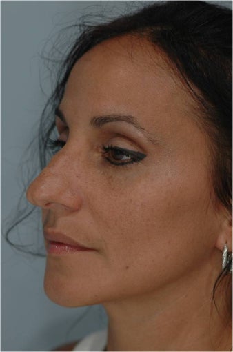 Rhinoplasty before 292543