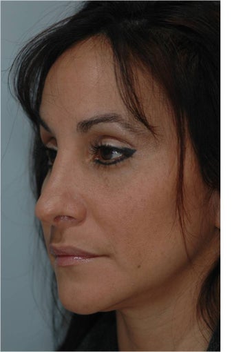 Rhinoplasty after 292543