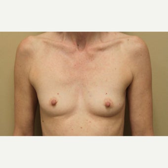 45-54 year old woman treated with Breast Augmentation before 1651362