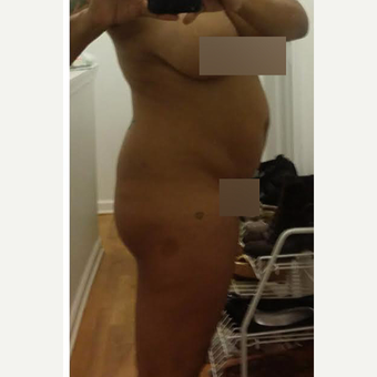 35-44 year old woman treated with Brazilian Butt Lift before 3539090