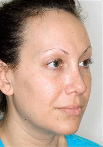 Rhinoplasty after 1023309