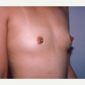 25-34 year old woman treated with Breast Augmentation before 3538720
