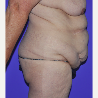 55-64 year old woman treated with Body Lift before 3455257