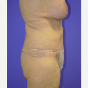 55-64 year old woman treated with Body Lift after 3455257
