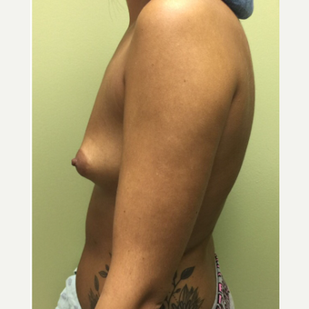 18-24 year old woman treated with Breast Augmentation before 3400595