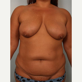 35-44 year old woman treated with Breast Fat Transfer before 3502642