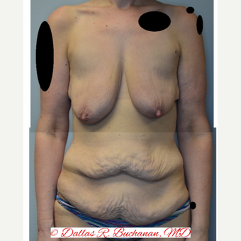 25-34 year old woman treated with Mommy Makeover before 3242216