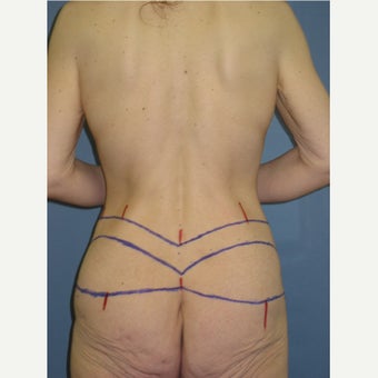 25-34 year old woman treated with Body Lift before 1835106