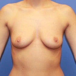 25-34 year old woman treated with Sientra Breast Implants before 1858262