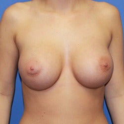 25-34 year old woman treated with Sientra Breast Implants after 1858262