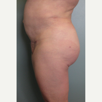 Brazilian Buttock Lift, Liposuction of the Abdomen & Flanks after 3852927