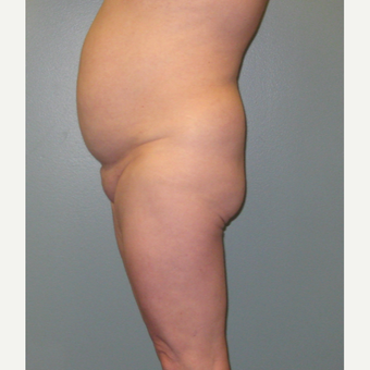 Brazilian Buttock Lift, Liposuction of the Abdomen & Flanks before 3852927