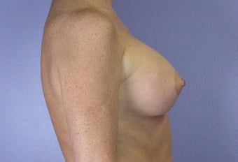 45-54 year old woman treated with Breast Augmentation after 3278111