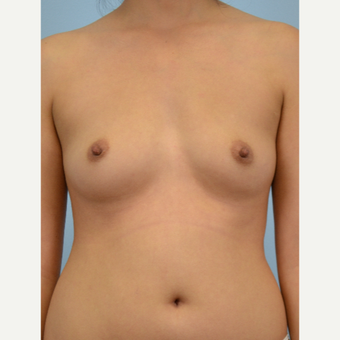 34 year old woman treated with Breast Fat Transfer before 3432113