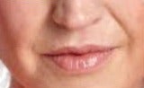 55-64 year old woman treated with Lip Augmentation after 2986797
