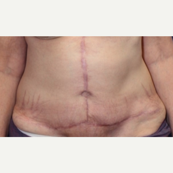 52 year old man treated with a Tummy Tuck after 3702393