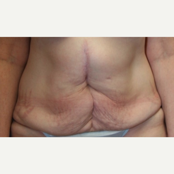 52 year old man treated with a Tummy Tuck before 3702393