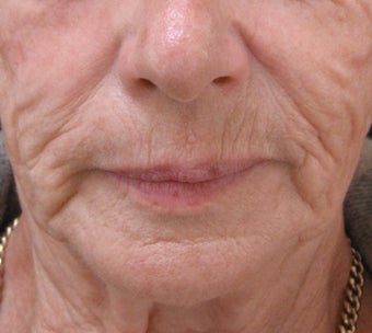 Reduce fine lines around the mouth with dermal fillers before 3364370