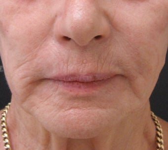 Reduce fine lines around the mouth with dermal fillers after 3364370