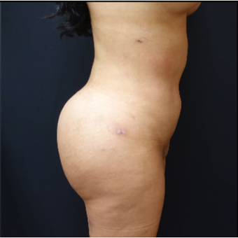 25-34 year old woman treated with Brazilian Butt Lift after 3286163