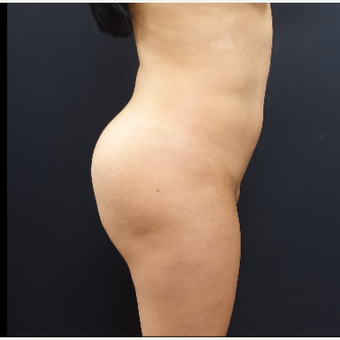 25-34 year old woman treated with Brazilian Butt Lift before 3286163