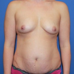 25-34 year old woman treated with Mommy Makeover before 1860542