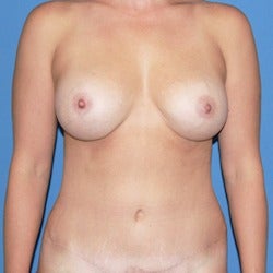 25-34 year old woman treated with Mommy Makeover after 1860542