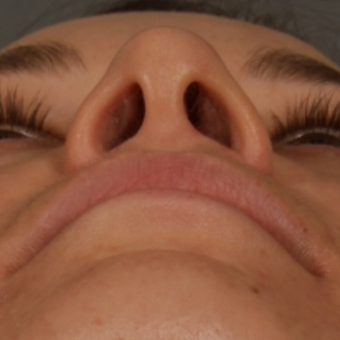 25-34 year old woman treated with Rhinoplasty after 3092350