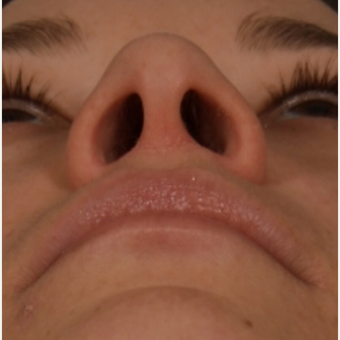 25-34 year old woman treated with Rhinoplasty before 3092350