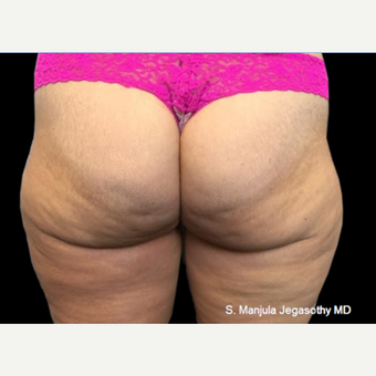 Viora® Radiofrequency Laser for Cellulite and Buttocks Shaping before 3735874