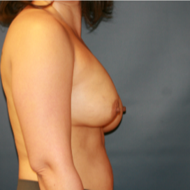 35-44 year old woman treated with Breast Implant Revision before 3555562