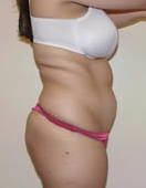 Liposuction 1029782